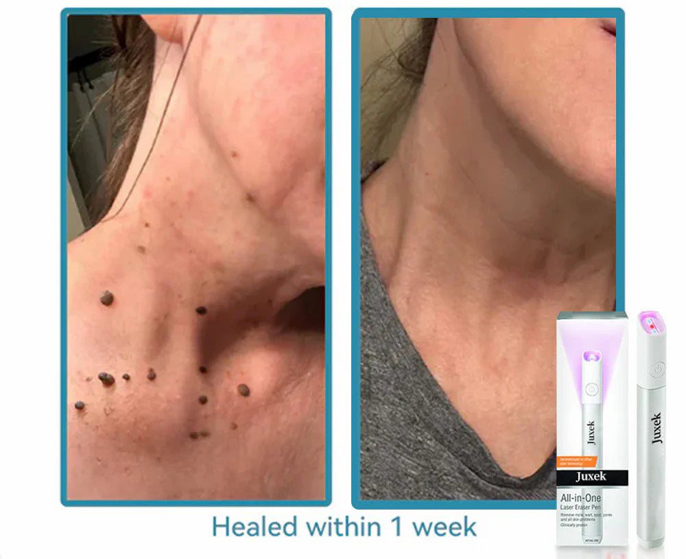 All-in-One CO₂ Laser Eraser Pen | Removes Moles, Warts, Skin Flaws & Pigmentation